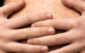 sarampion portada 290x180 jpg