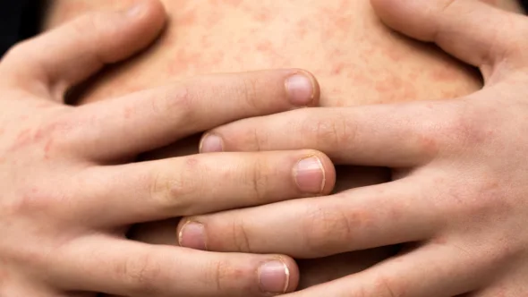 sarampion portada 590x332 jpg