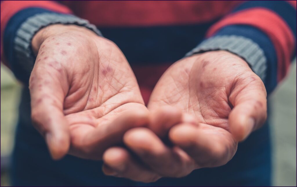 virus coxsackie Canva scaled 1