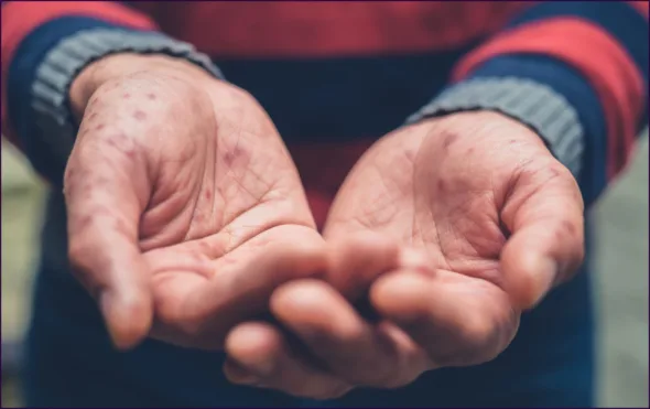 virus coxsackie Canva scaled 1 590x371 jpg