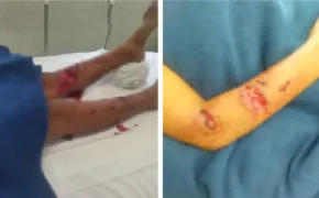 jauria_ataca_a_nino_de_10_anos_en_tlapacoyan_esta_hospitalizado