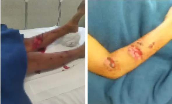 jauria ataca a nino de 10 anos en tlapacoyan esta hospitalizado