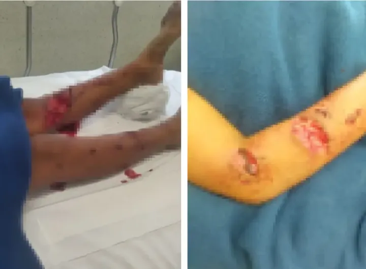 jauria ataca a nino de 10 anos en tlapacoyan esta hospitalizado